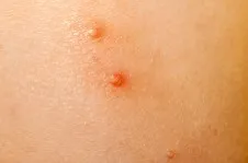 Le molluscum contagiosum